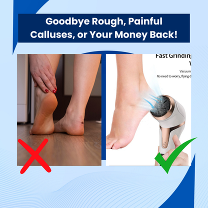 SonicSoothe™ - Foot Callus Remover