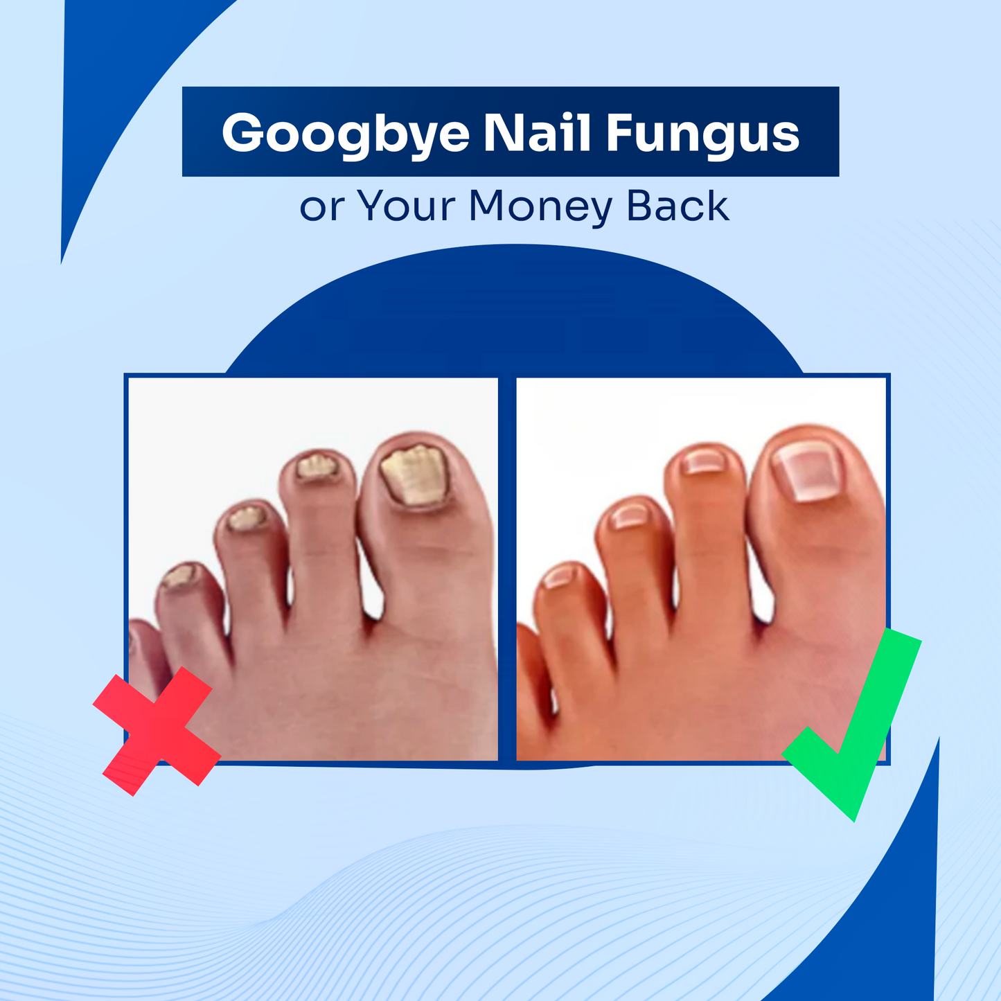 DermalPulse®️ Nail Fungus Treatment