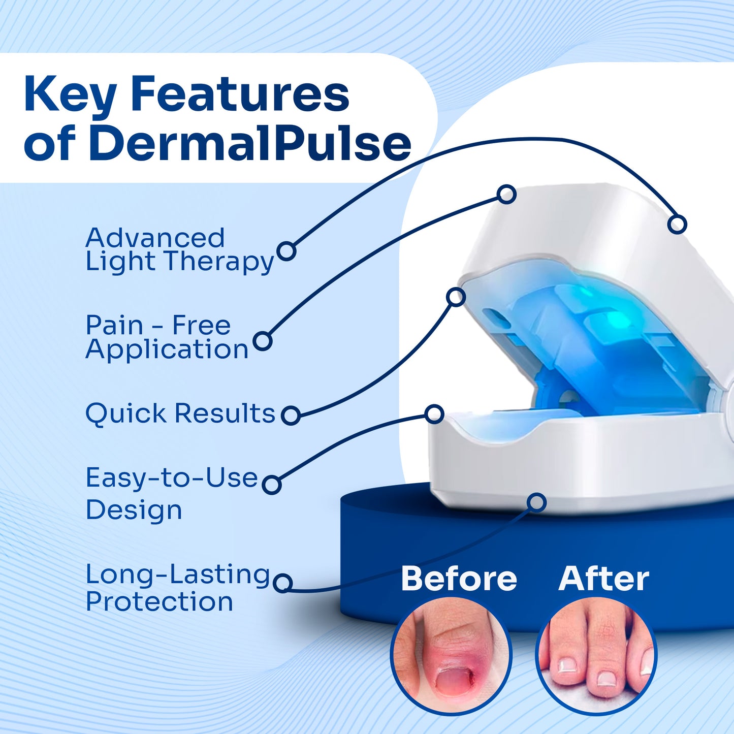 DermalPulse™-Nagelpilz-Behandlung