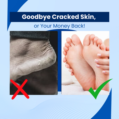 ToughSkin™ - Cracked Skin Treatment