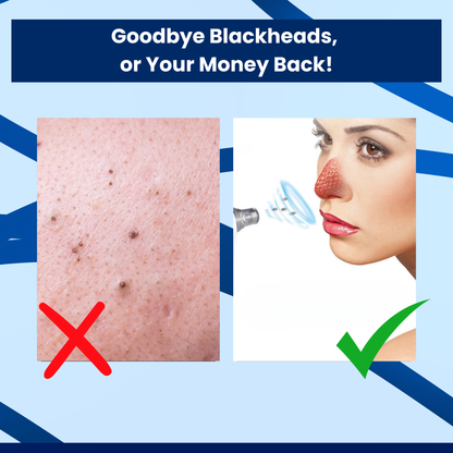 ClearPulse Pro™ - Blackhead Remover