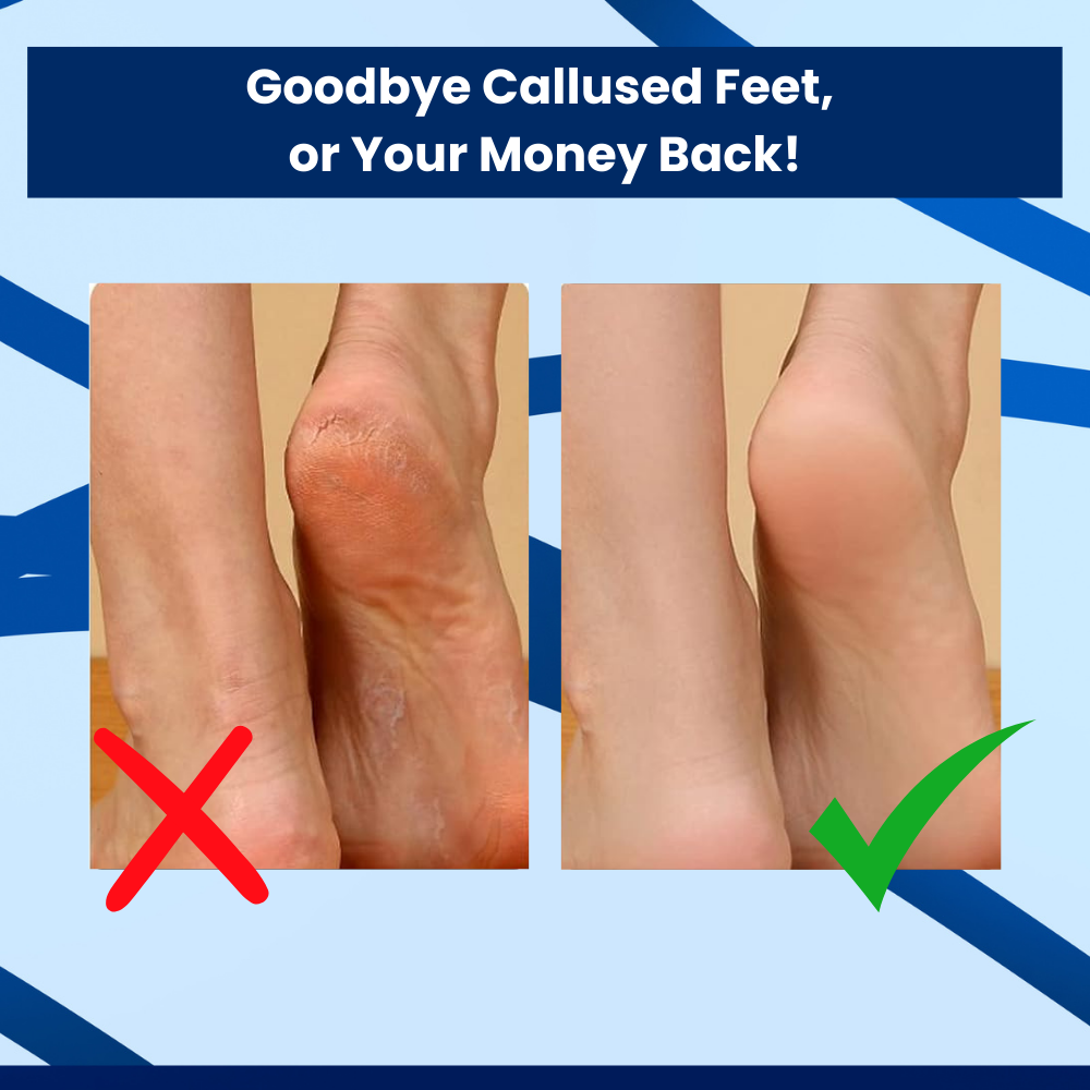 SoleCare™ - Feet Callus Remover