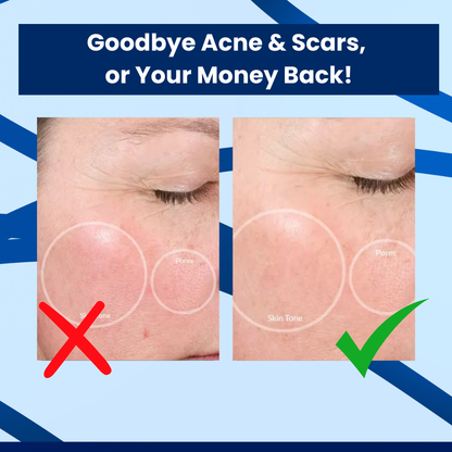 LumaClear™ - Acne Treatment